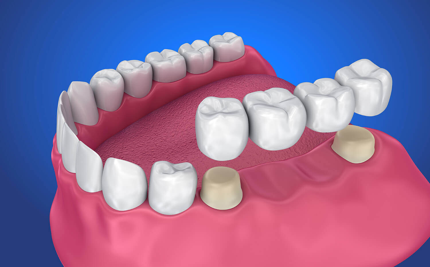 Crowns & Bridge at Dental Sense
