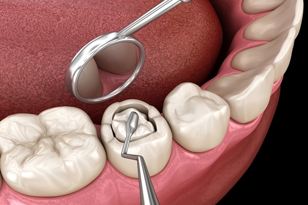 Fillings at Dental Sense