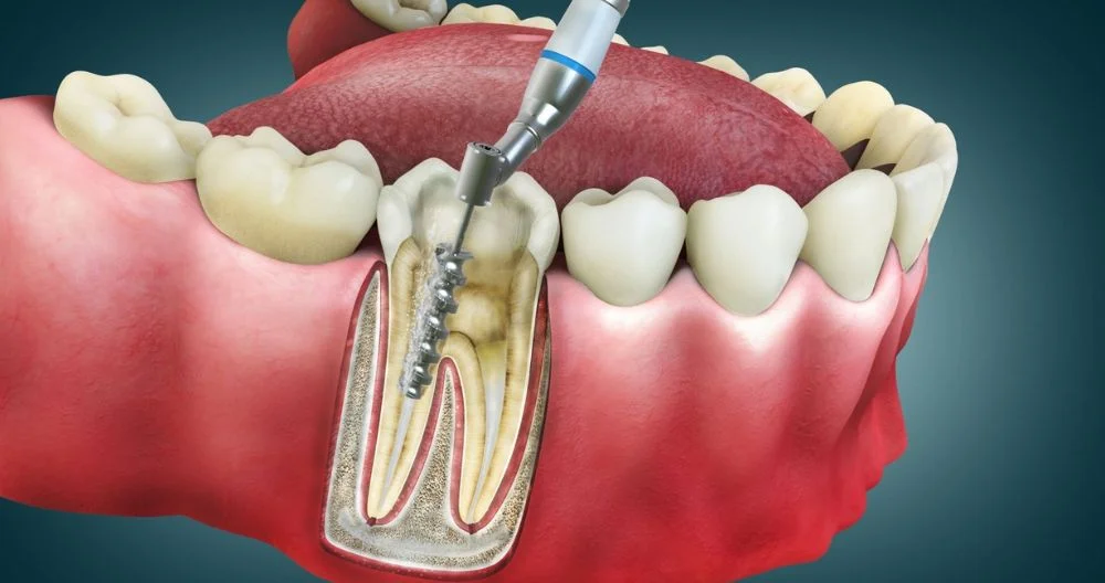 Root canal treatment at Dental Sense