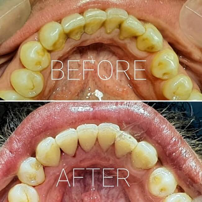 Scaling and polishing at Dental Sense