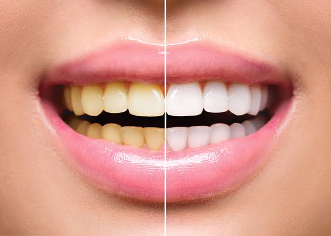 Teeth whitening at Dental Sense