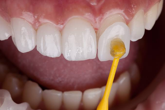 Dental veneers at Dental Sense