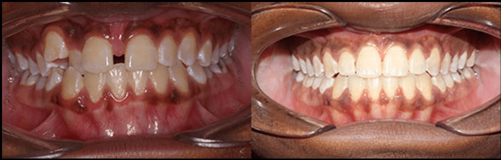 Orthodontic and smile improvement result preview.